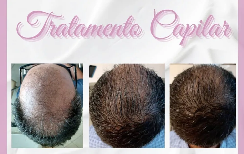 Evolução em três etapas de tratamento capilar para calvície