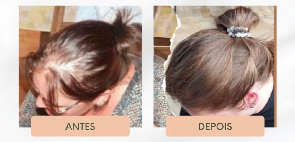 Antes e depois de tratamento para alargamento da risca em paciente feminina