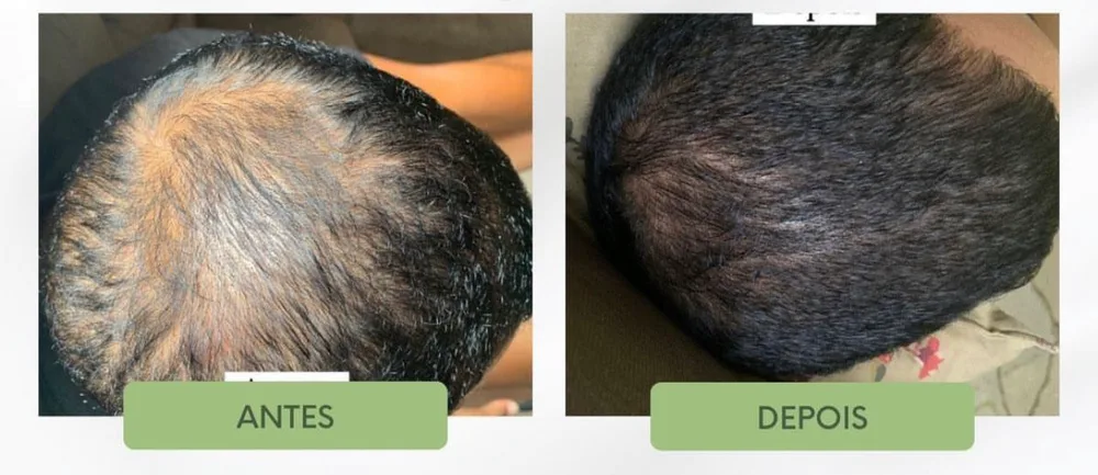 Antes e depois de tratamento para alopecia androgenética masculina