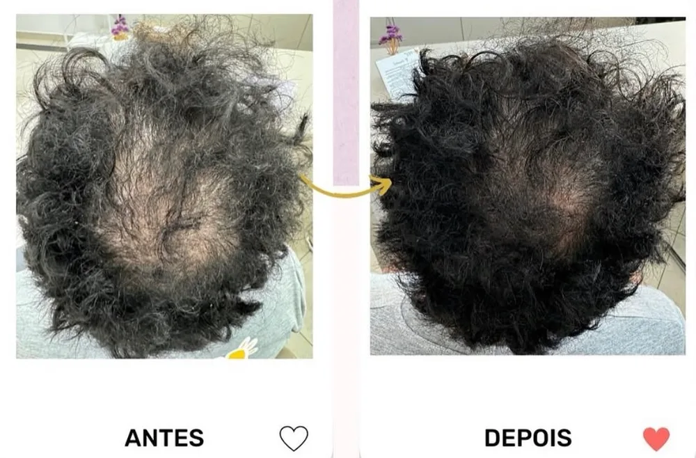 Antes e depois de tratamento capilar com recuperação de densidade no topo da cabeça