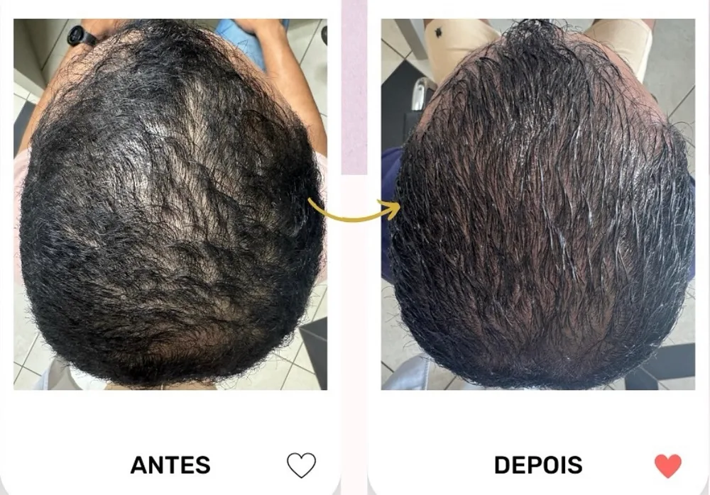 Antes e depois de tratamento para queda capilar em cabelo liso