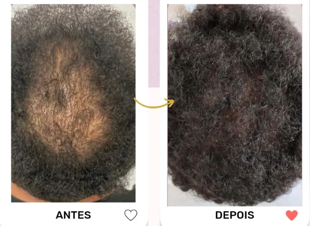 Antes e depois de tratamento capilar em cabelo crespo com falha central